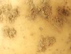 Pomme de terre - Gale poudreuse (Spongospora subterranea)